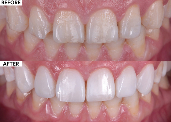 Composite Veneers